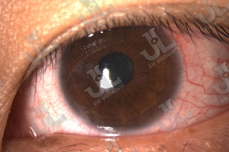 Dr Jimmy Lim JL Eye Specialists Clinic in Singapore Eye Care Contact Lens