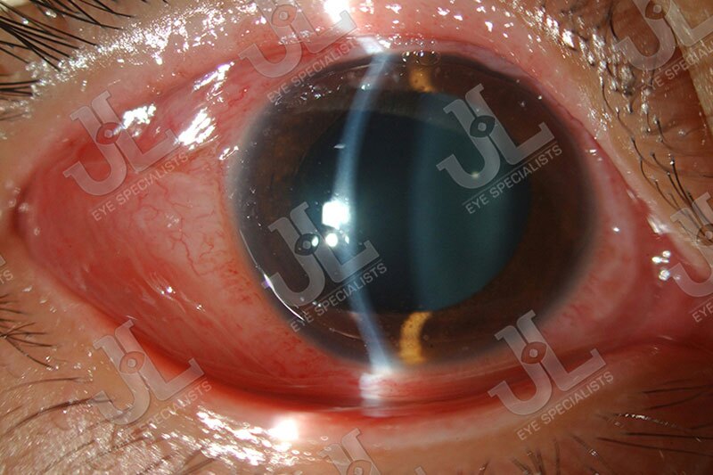 Dr Jimmy Lim JL Eye Specialists Clinic in Singapore Eye Disease Imaging Scleritis