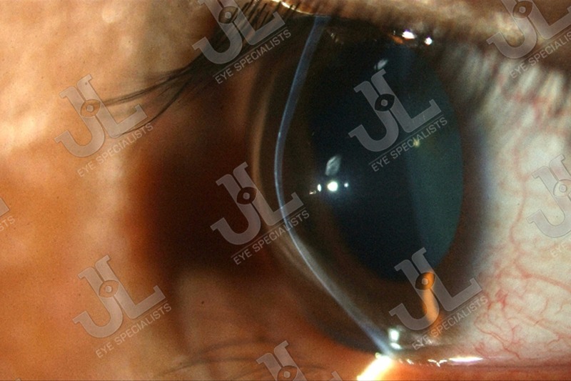 Dr Jimmy Lim JL Eye Specialists Cornea Keratoconus / Keratoectasia Imaging