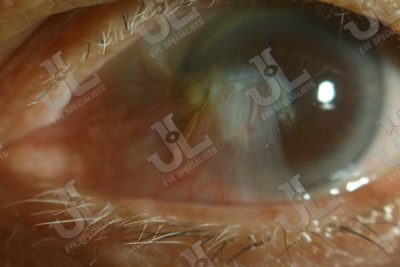 Dr Jimmy Lim JL Eye Specialists Pterygium Cornea Left Eye