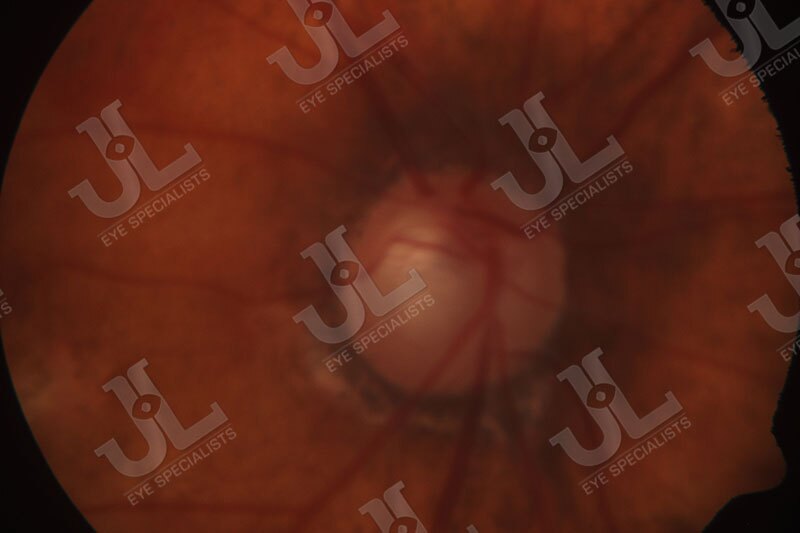 low-or-normal-tension-glaucoma-imaging