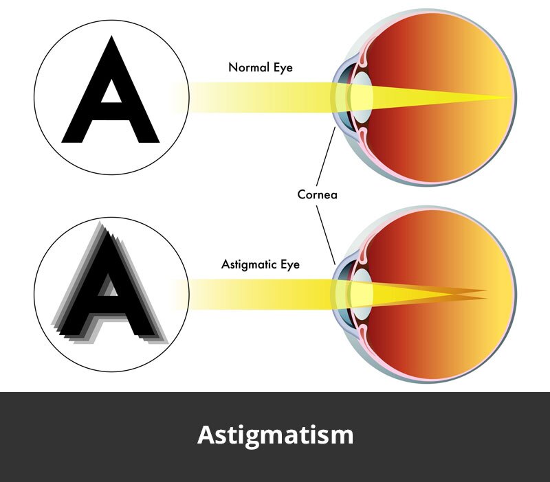 jl-eye-specialists-clinic-singapore-astigmatism