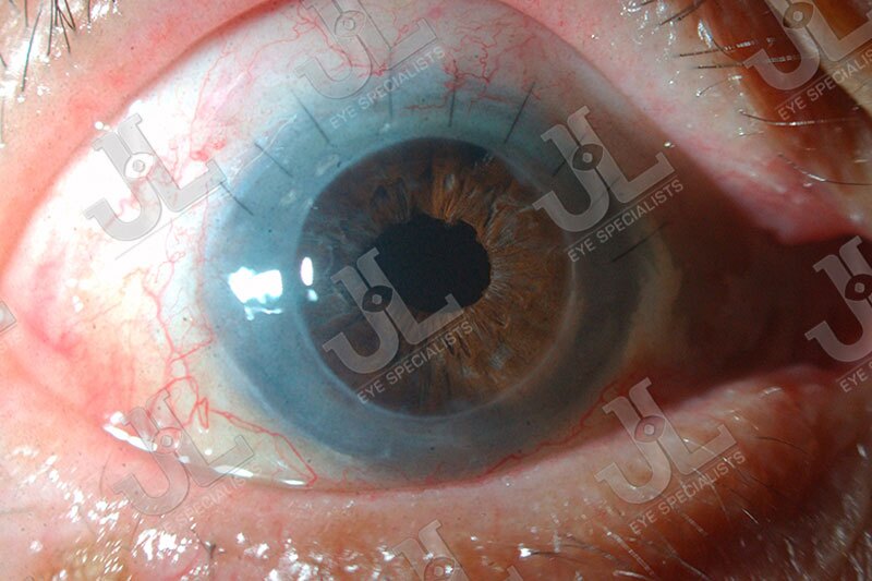 cornea-imaging-full-eye