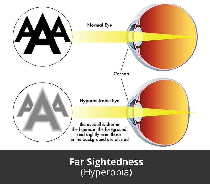 jl-eye-specialists-clinic-singapore-far-sightedness-hyperopia