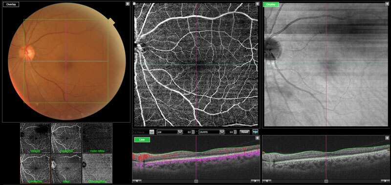 Dr Jimmy Lim JL Eye Specialists Clinic in Singapore OCT Angiography Healthy Macula
