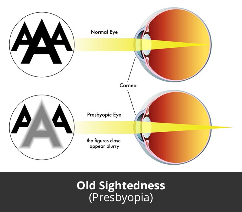 jl-eye-specialists-clinic-singapore-old-sightedness-presbyopia