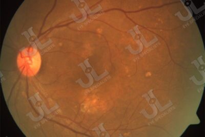 Dr Jimmy Lim JL Eye Specialists Clinic in Singapore Retina Service Retinal Fundus Macular Degeneration Imaging Light