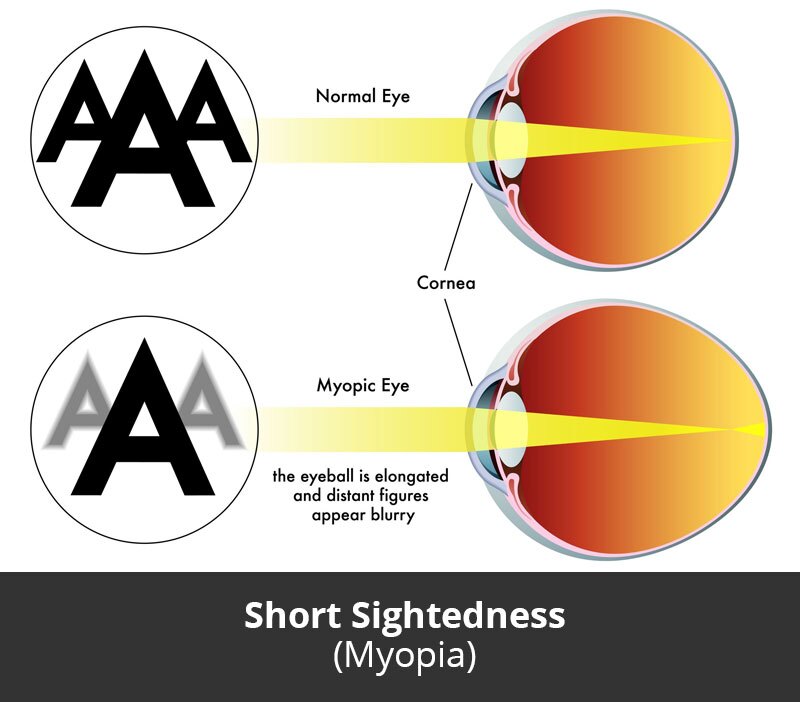Dr Jimmy Lim JL Eye Specialists Short Sightedness Myopia Chart