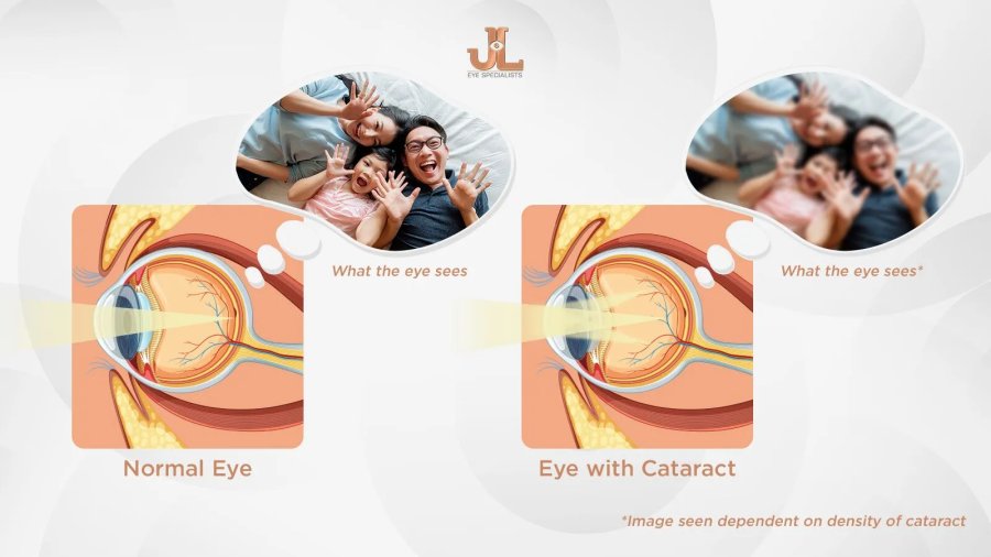Jl-Eye-Normal-eye-Vs-Cataract-eye